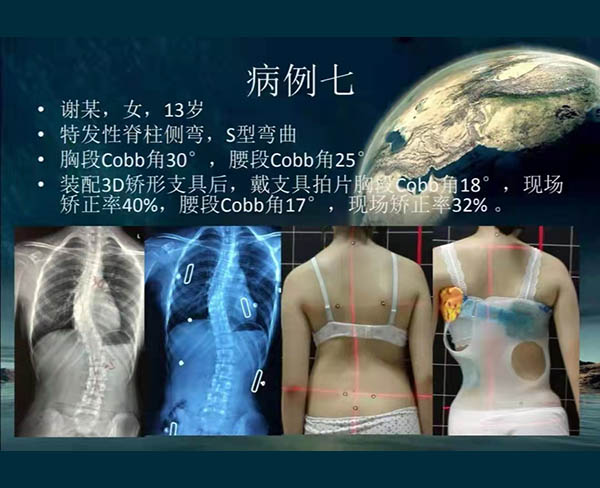 脊柱侧弯矫案例 (11)